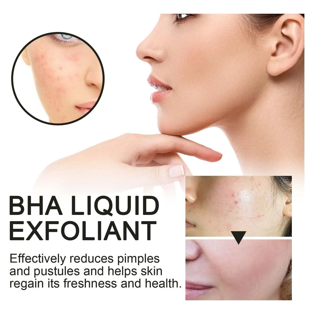 BHA Liquid Exfoliant, Lightening Acne Seal Pore-Tightening And Moisturizing Skin Essence V.I.P Digital Presence