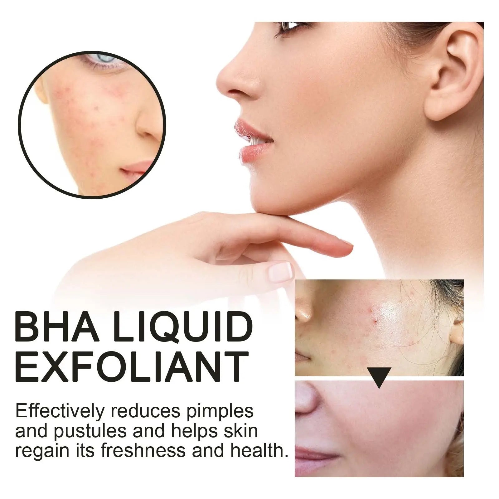 BHA Liquid Exfoliant, Lightening Acne Seal Pore-Tightening And Moisturizing Skin Essence V.I.P Digital Presence