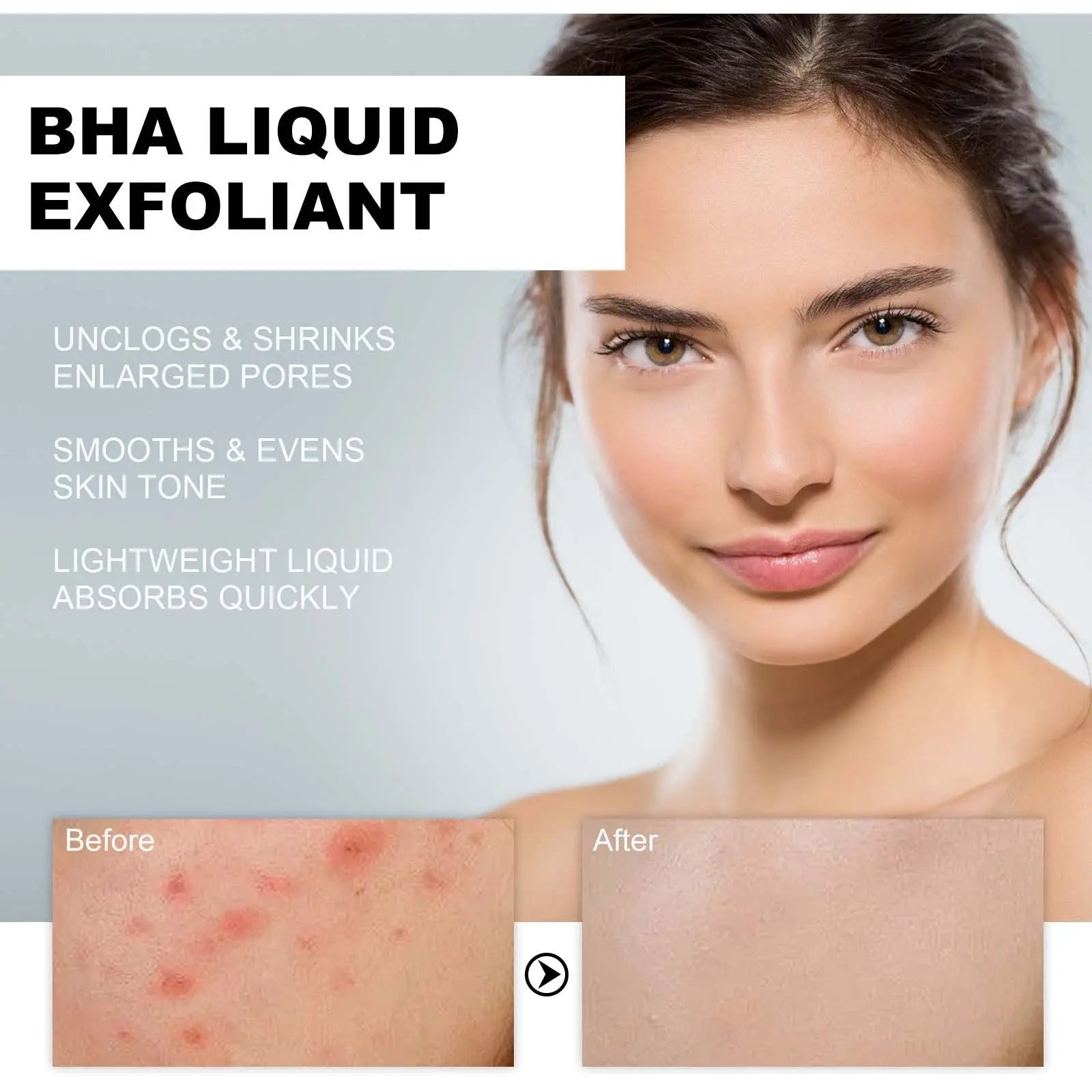 BHA Liquid Exfoliant, Lightening Acne Seal Pore-Tightening And Moisturizing Skin Essence V.I.P Digital Presence